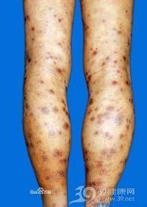 花柳病图片,疾病特征与防治要点